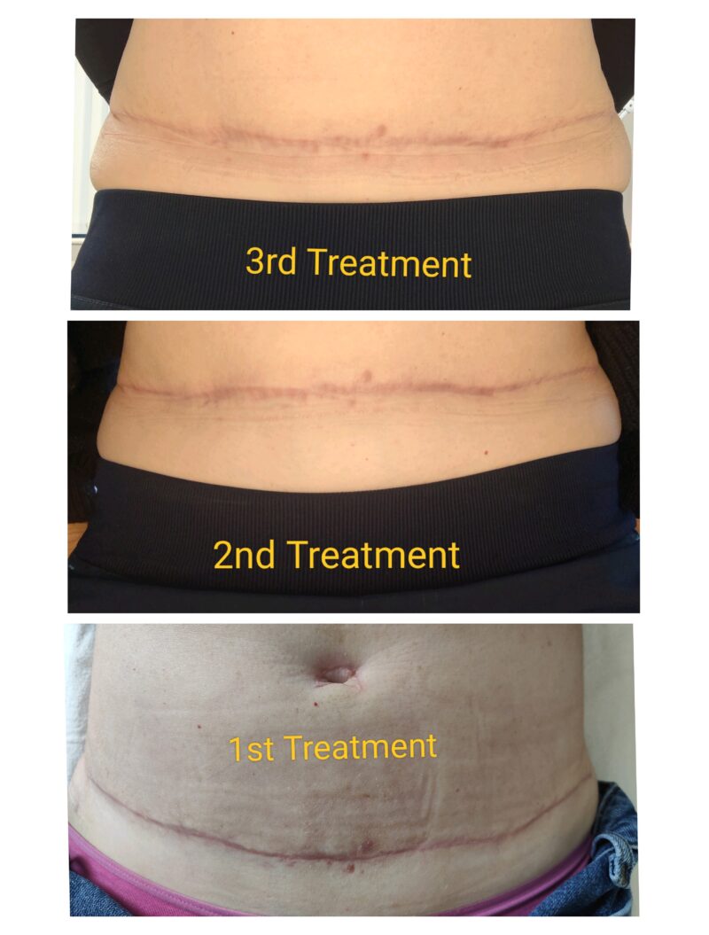 Diep Flap Scar Treatment Diep Flap Scar Treatment cork