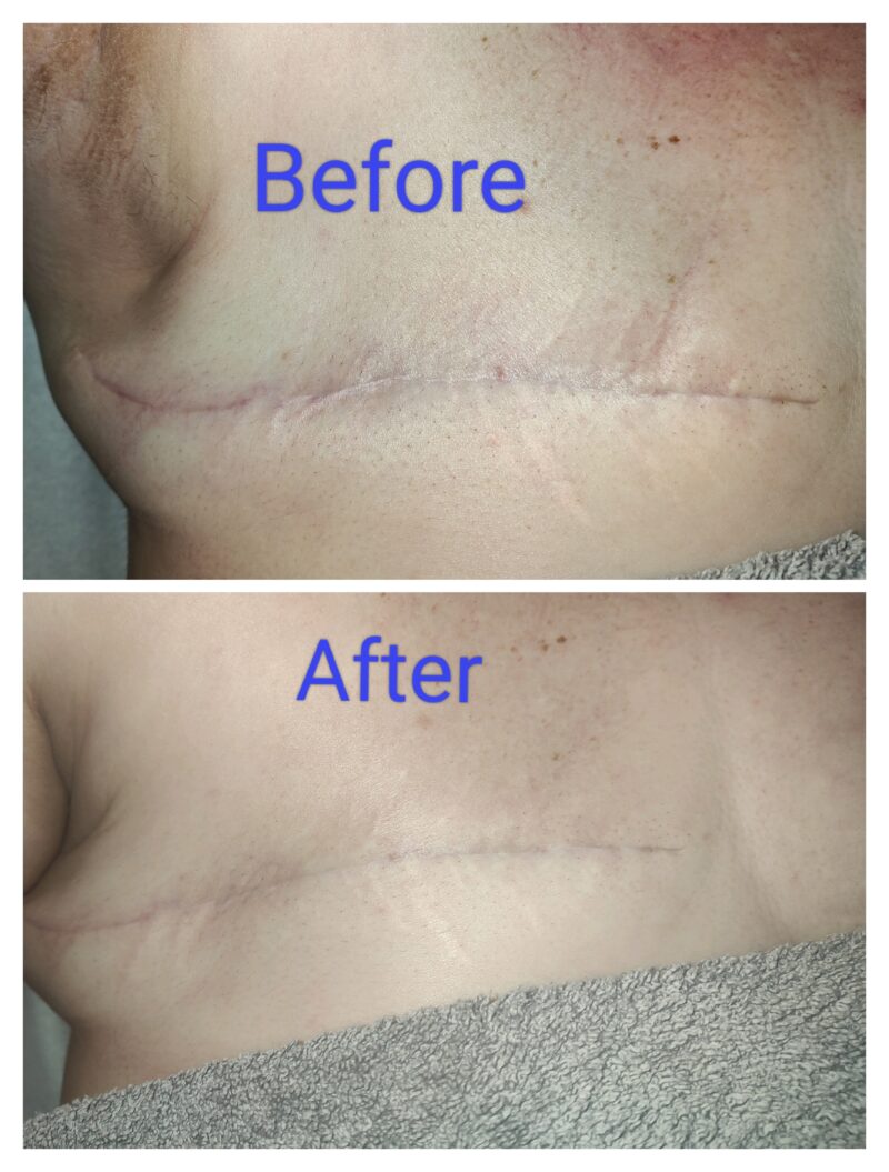 Mastectomy Scar before and after oncology scar tissue repair and recovery cork